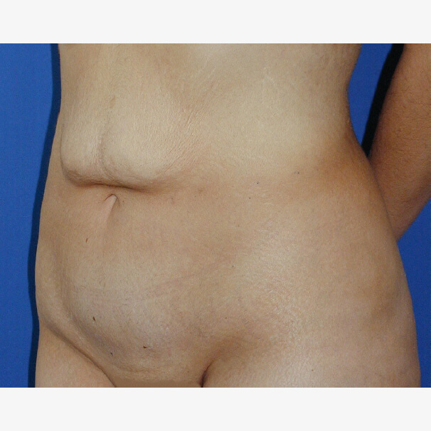 Abdominal reduction (tummy tightening, abdominoplasty, dermolipectomy)